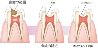 歯の神経を残す「歯髄温存療法(MTA)」に対応可能です！