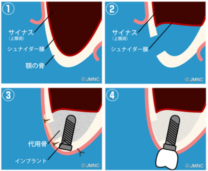 サイナスリフト（開窓法）