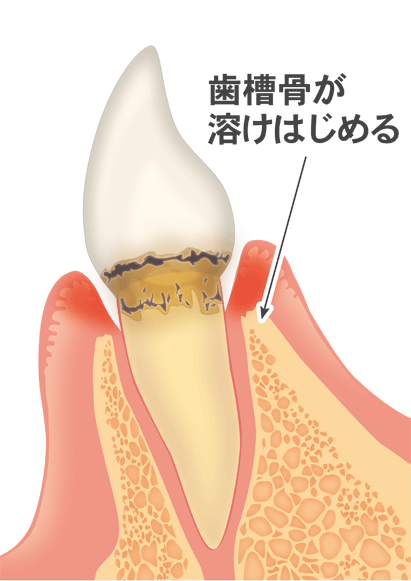 軽度歯周炎