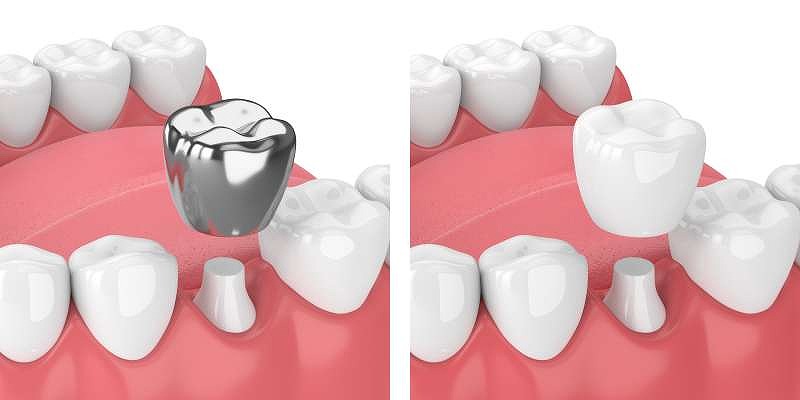 銀歯とセラミックの違い